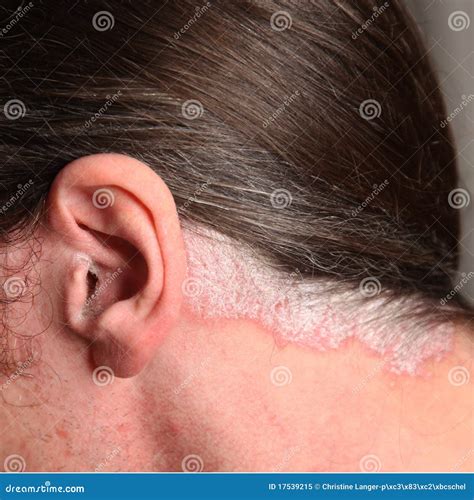 psoriasi dentro le orecchie